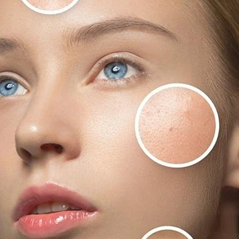 Acne Scar Removal